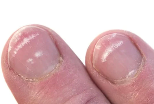Understanding White Spots On The Nails